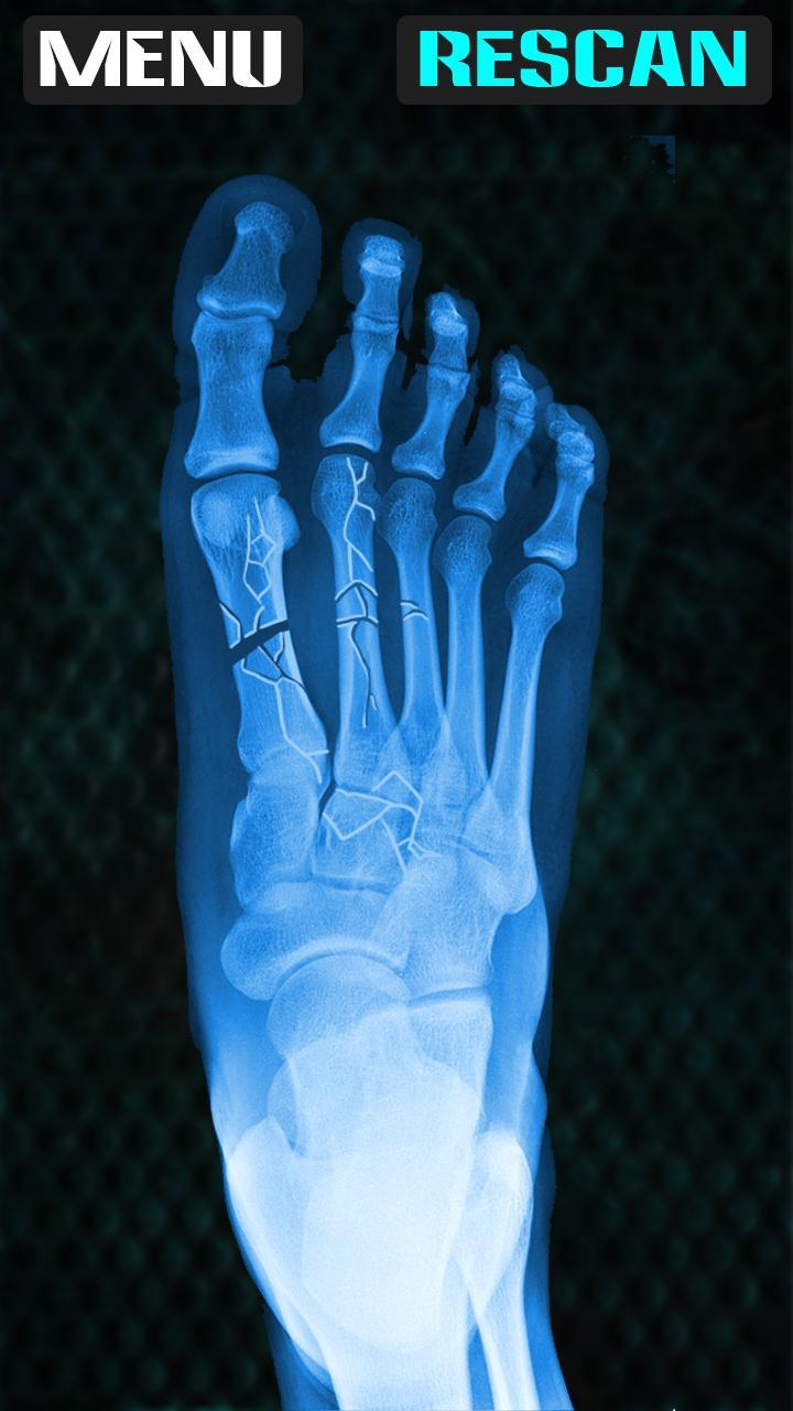 Xray Fracture Foot Prank